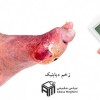 درمان زخم دیابتی | کلینیک بهبودان