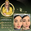 میکروبلیدینگ در غرب تهران