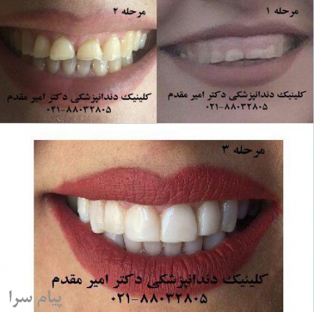دندانپزشک تهران    ملاصدرا 88032805 کلینیک ایمپلنت