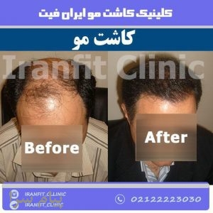کاشت مو ایران فیت