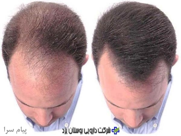 داروی درمان ریزش مو  آمیلا 