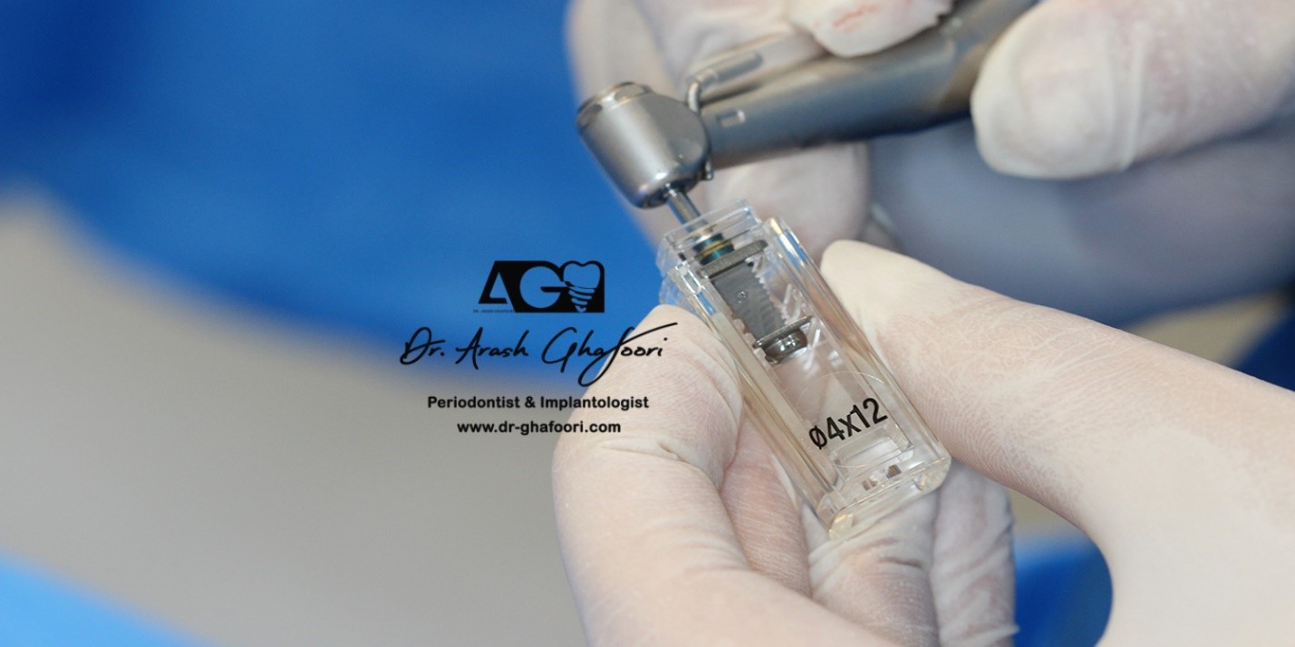 ایمپلت دندان در افراد مبتلا به دیابت