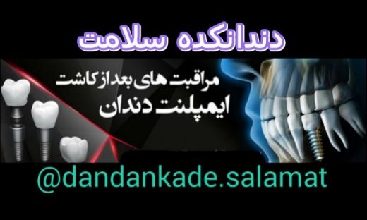 ایمپلنت کره ای و اروپایی