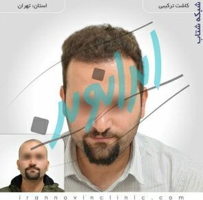 کاشت مو طبیعی با یک میلیون تومان