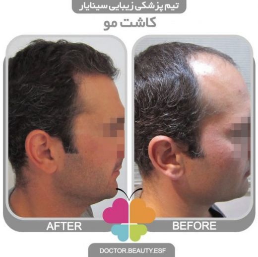 کاشت مو در اصفهان