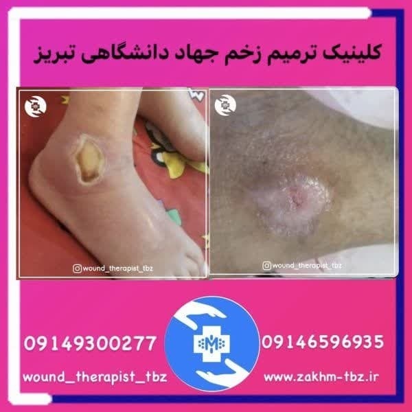 درمان زخم تبریز