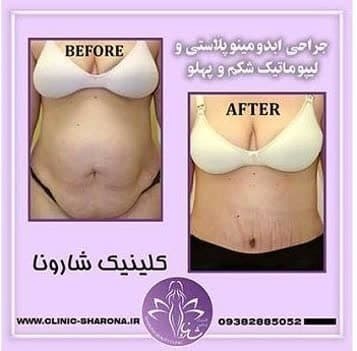 پروتز سینه و لیپوماتیک در ستارخان